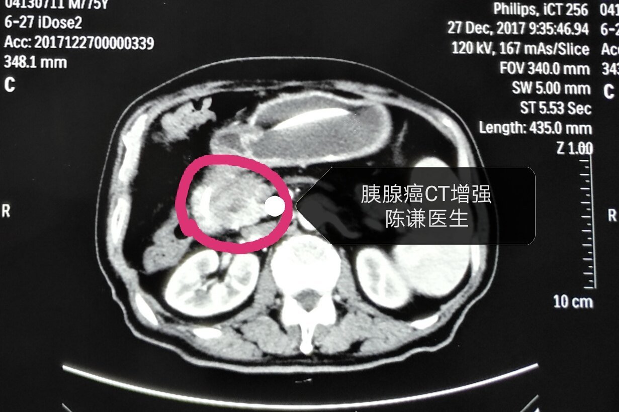 Contrast-enhanced CT before HIFU treatment